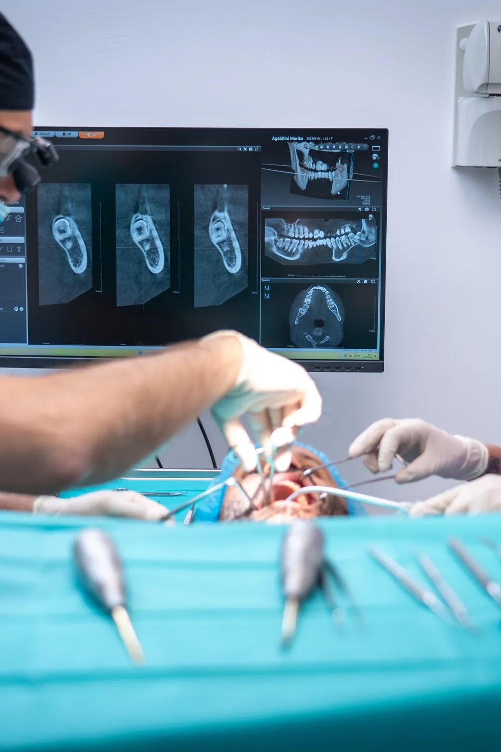 Chirurgia implantare a Perugia, intervento eseguito da odontoiatra Bittarello